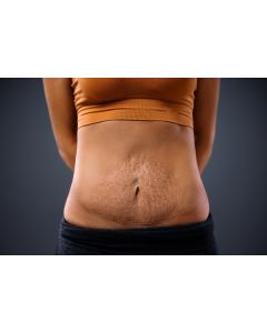 Morpheus Offers - Stretch Marks